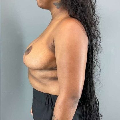 Breast Reduction Before & After Patient #861