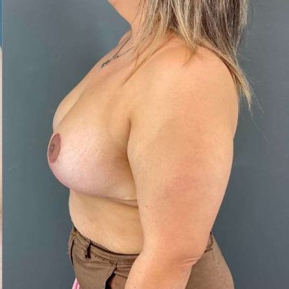 Breast Reduction Before & After Patient #872
