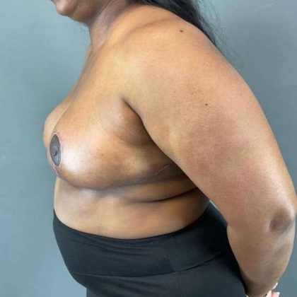 Breast Reduction Before & After Patient #883