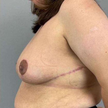 Breast Reduction Before & After Patient #894