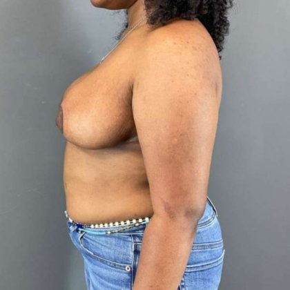 Breast Reduction Before & After Patient #916
