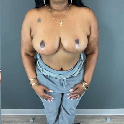 Breast Reduction Before & After Patient #927