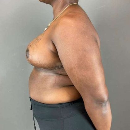 Breast Reduction Before & After Patient #938