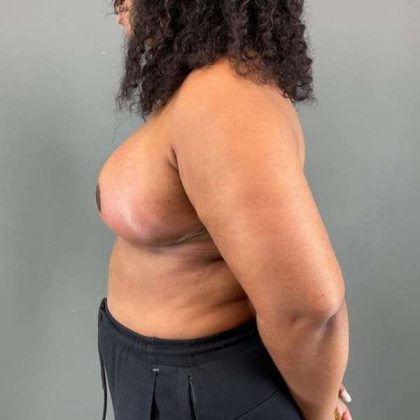 Breast Reduction Before & After Patient #967