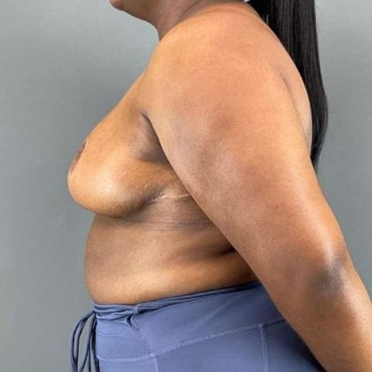 Breast Reduction Before & After Patient #978