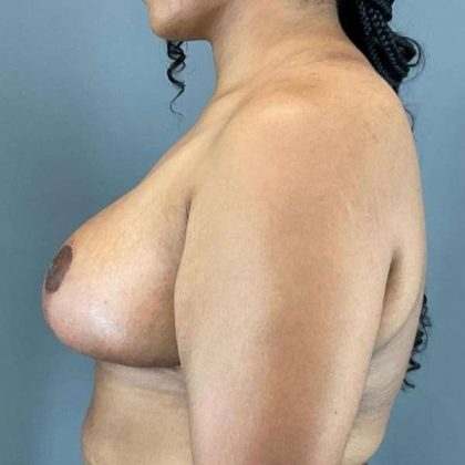 Breast Reduction Before & After Patient #998