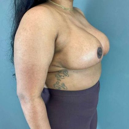 Breast Reduction Before & After Patient #1018