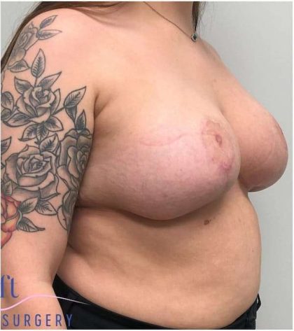 Breast Reduction Before & After Patient #1029