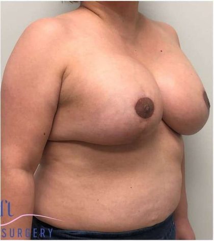 Breast Lift Before & After Patient #1040