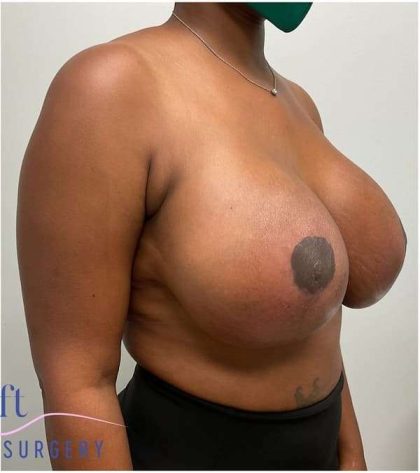 Breast Lift Before & After Patient #1051