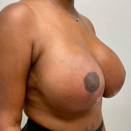 Breast Lift Before & After Patient #1084