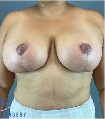 Breast Lift Before & After Patient #1131