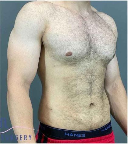 Bodytite Before & After Patient #280