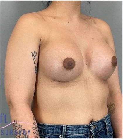 Breast Augmentation Before & After Patient #1219