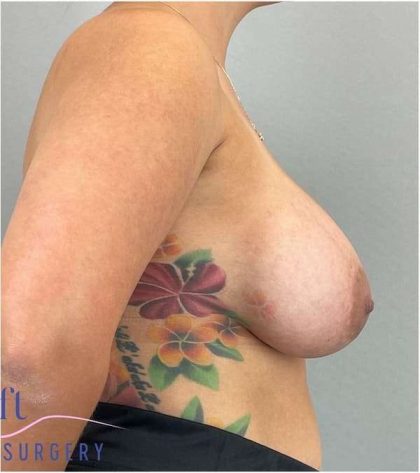 Breast Augmentation Before & After Patient #1230