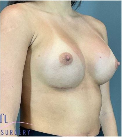 Breast Augmentation Before & After Patient #1252