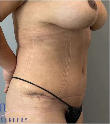 Tummy Tuck Before & After Patient #303