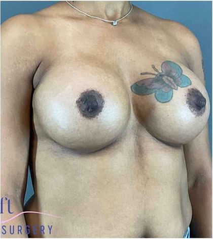 Breast Augmentation Before & After Patient #1296