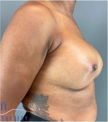 Breast Augmentation Before & After Patient #1307