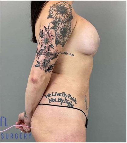 Liposuction Before & After Patient #177