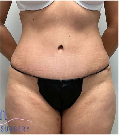 Tummy Tuck Before & After Patient #357