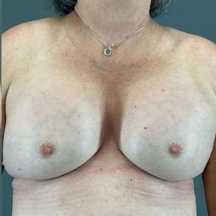 Breast Augmentation Before & After Patient #1450