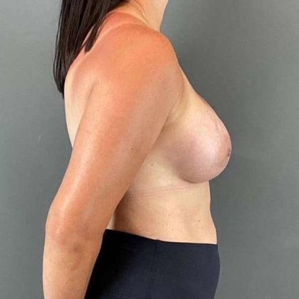Breast Augmentation Before & After Patient #1472