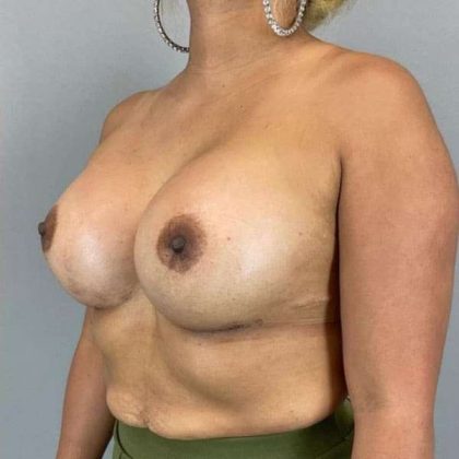 Breast Augmentation Before & After Patient #1483