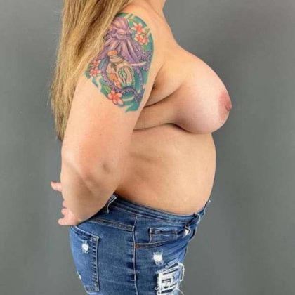 Breast Augmentation Before & After Patient #1494