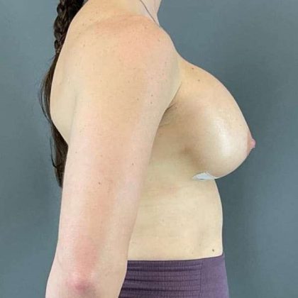 Breast Augmentation Before & After Patient #1547