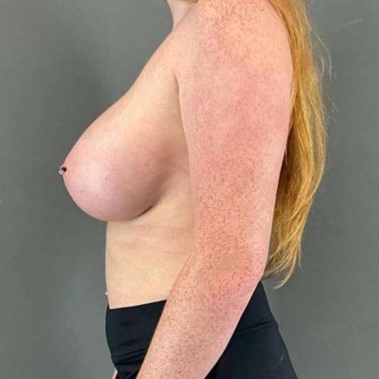 Breast Augmentation Before & After Patient #1558