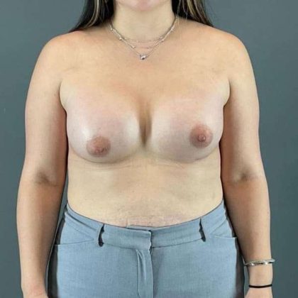 Breast Augmentation Before & After Patient #1591