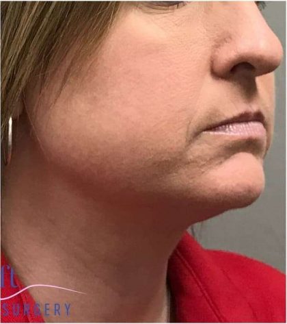 Necktite Before & After Patient #1624