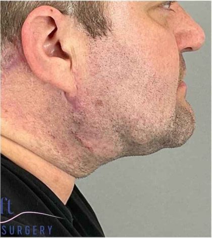 Neck Lift Before & After Patient #1660