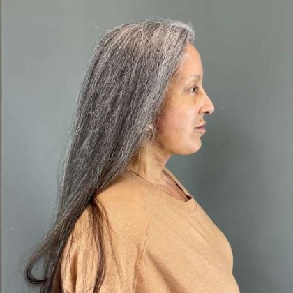 Neck Lift Before & After Patient #1671