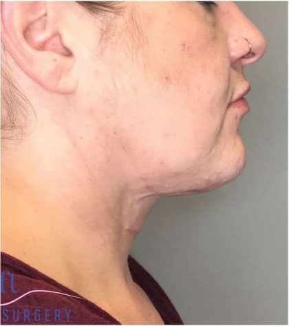 Neck Lift Before & After Patient #1696