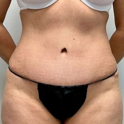 Tummy Tuck Before & After Patient #379
