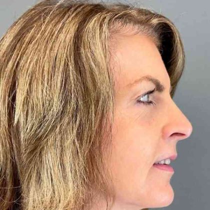 Eyelid Surgery Before & After Patient #1786