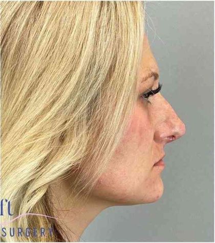 Rhinoplasty Before & After Patient #1807