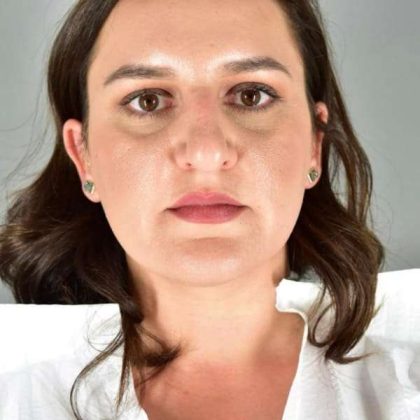 Rhinoplasty Before & After Patient #1818