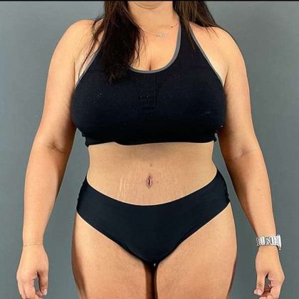 Tummy Tuck Before & After Patient #390