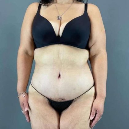 Tummy Tuck Before & After Patient #401