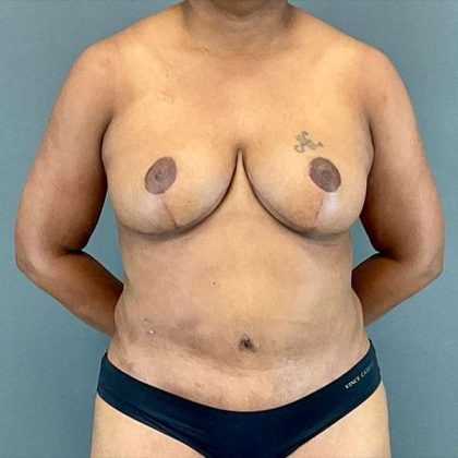 Tummy Tuck Before & After Patient #412