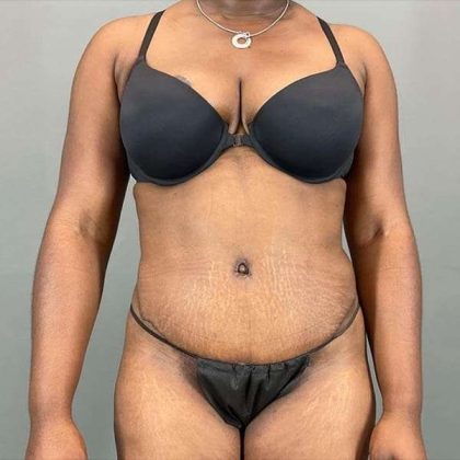 Tummy Tuck Before & After Patient #423