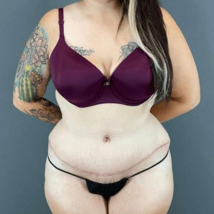 Tummy Tuck Before & After Patient #434