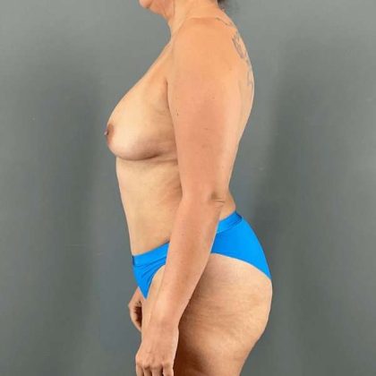 Tummy Tuck Before & After Patient #445