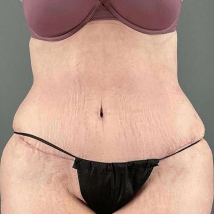 Tummy Tuck Before & After Patient #476
