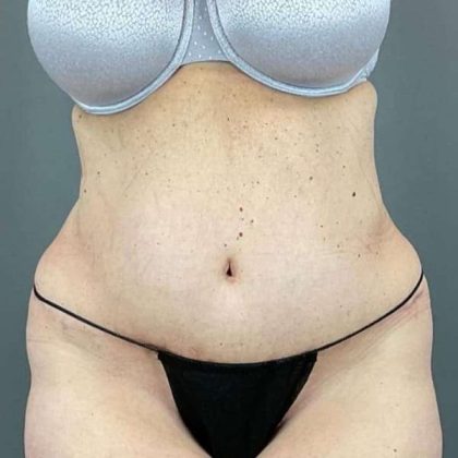 Tummy Tuck Before & After Patient #498
