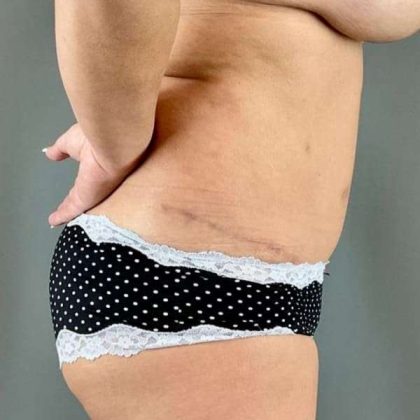 Tummy Tuck Before & After Patient #509