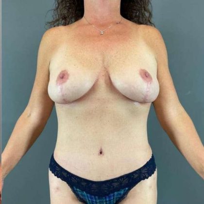 Tummy Tuck Before & After Patient #553